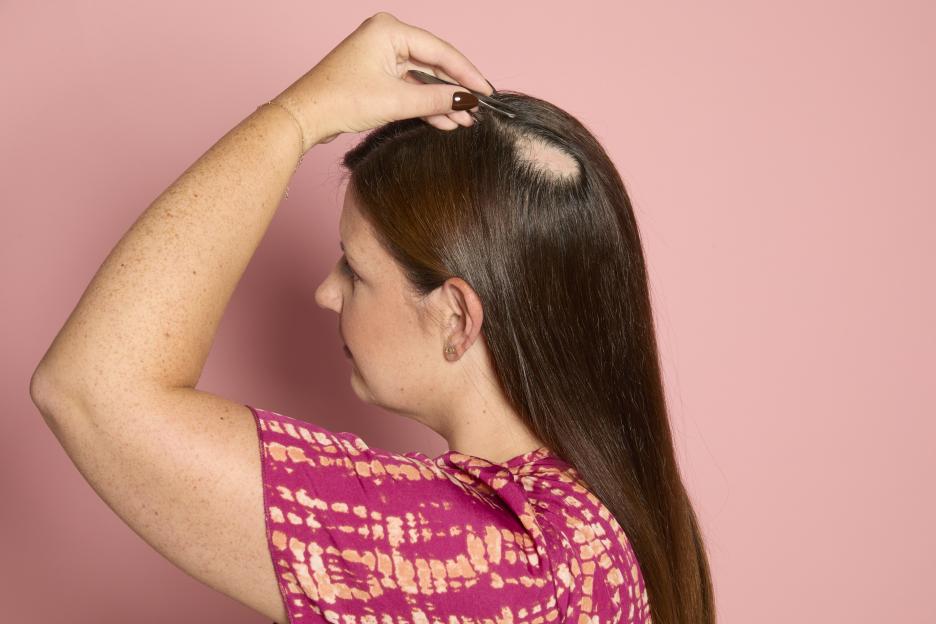 Charlotte Dodds pulling her hair with tweezers, showing a bald spot.