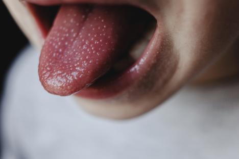 Close-up of a young boy's tongue with scarlet fever.