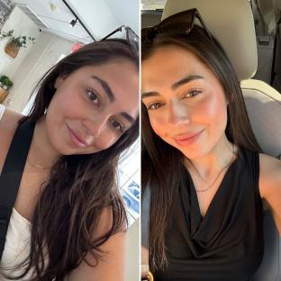 Before and after photos of a woman's face after weight loss.