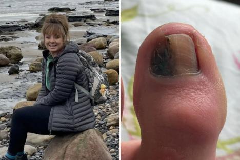 When I spotted ugly mark on my toenail I just covered it with nail varnish – I had no clue it was a sign of cancer