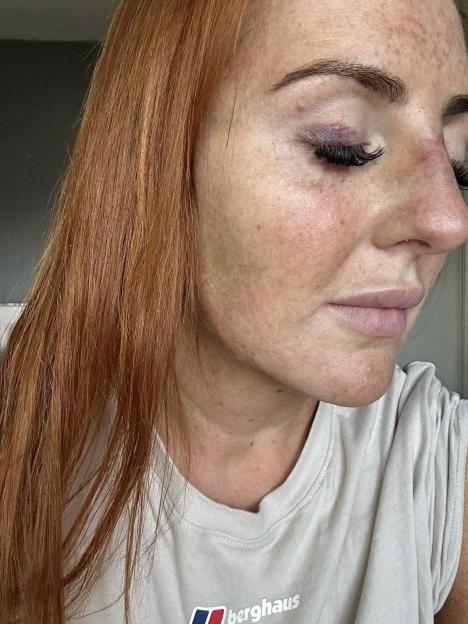 Close-up of a woman's face in profile, showing a dark bruise on her right eyelid and eyelash extensions.