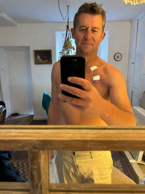 Zack Van Aarde shirtless in a mirror, with bandages on his chest.
