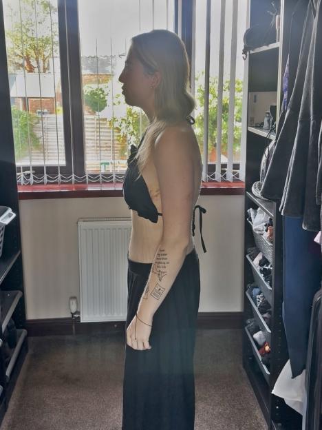 Woman in profile view showing her weight loss.