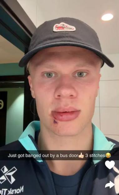 Erling Haaland needs three stitches as Man City star smashed by Norway team bus – but jokes Arsenal ace punched him