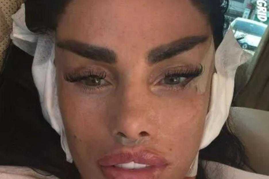 Katie Price shows off puffy face after MORE surgery in Turkey with before and after pics