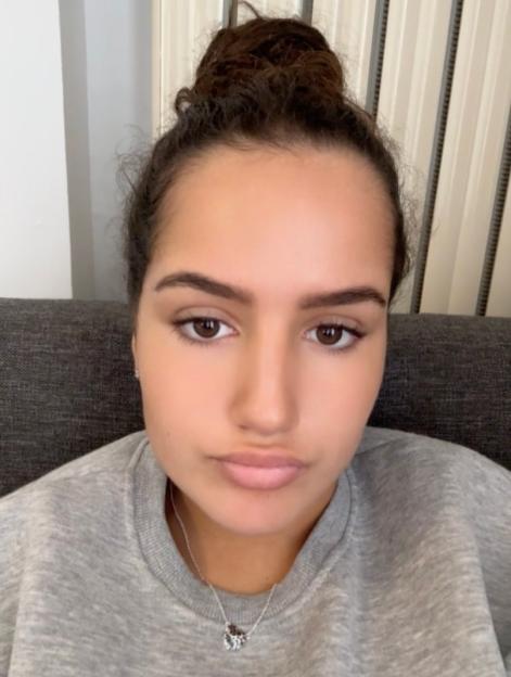 Photo of a young woman before a hair transplant.