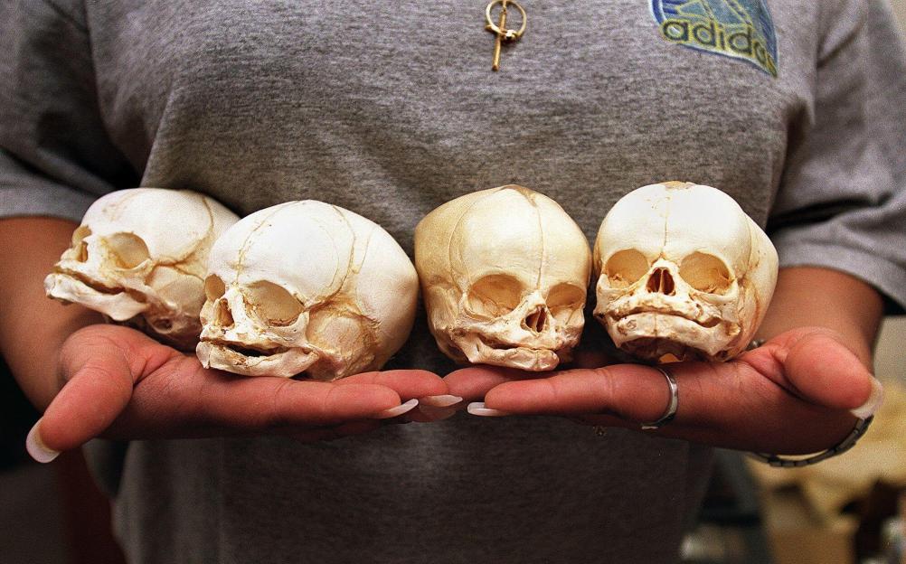 Four fetal skulls held in a person's hands.