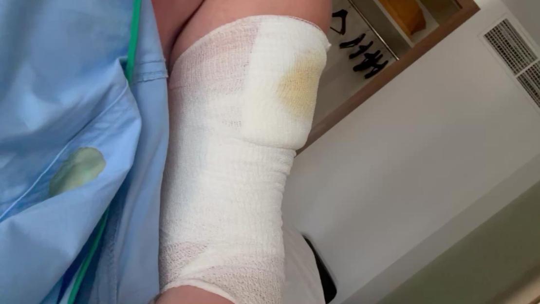 Samantha Shaw's bandaged leg after an altercation.