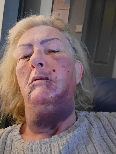 Close-up of a woman's bruised face and neck.