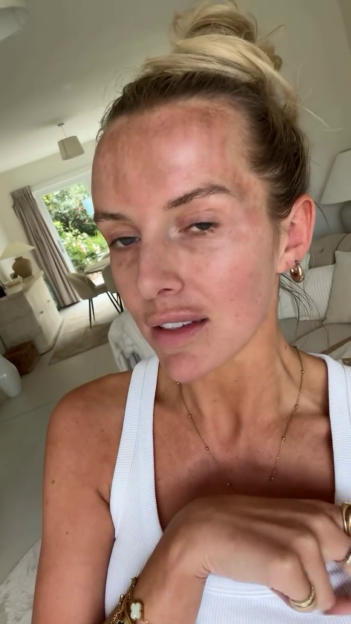 Faye Winter showing her skin and discussing her medical condition.