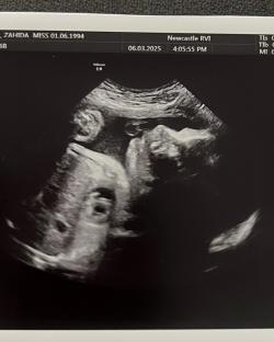 Ultrasound image of a fetus.