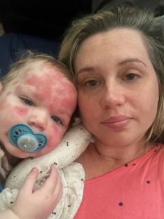 A mother and her baby son, whose body is covered in eczema.