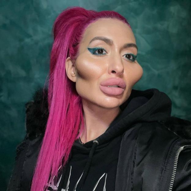 Anastasia Pokreshchuk with heavily augmented cheeks and lips.