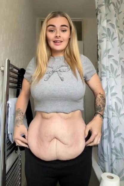 I’ve lost eight stone on Mounjaro but now I’ve got really bad loose skin – I have ‘second boobs’ and my legs are wrinkly