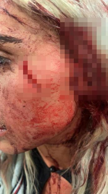 Graphic image of a woman's bloody facial injuries.