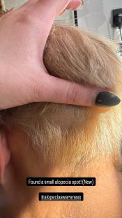Close-up of a small alopecia spot on a person's head.