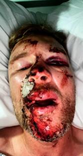 Close-up of Freddie Flintoff's injured face.