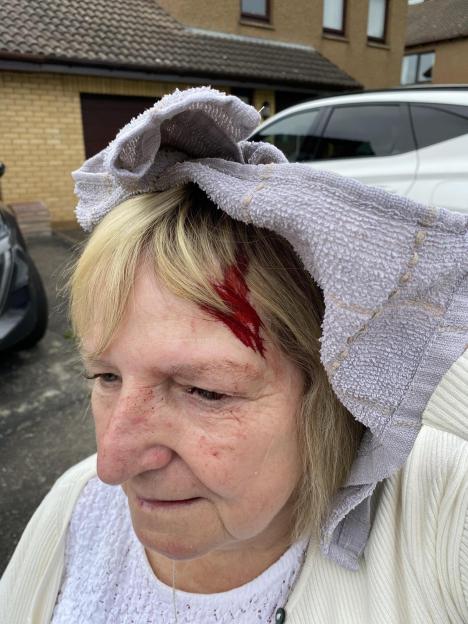Woman with a head wound after a seagull attack.