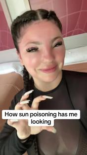 Woman with sun poisoning showing swollen face.