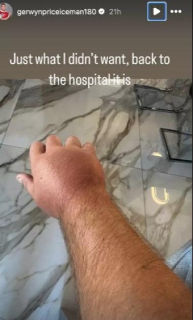 Severely swollen hand.