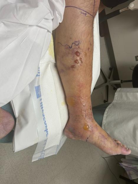 Leg with severe flesh-eating bacteria infection.