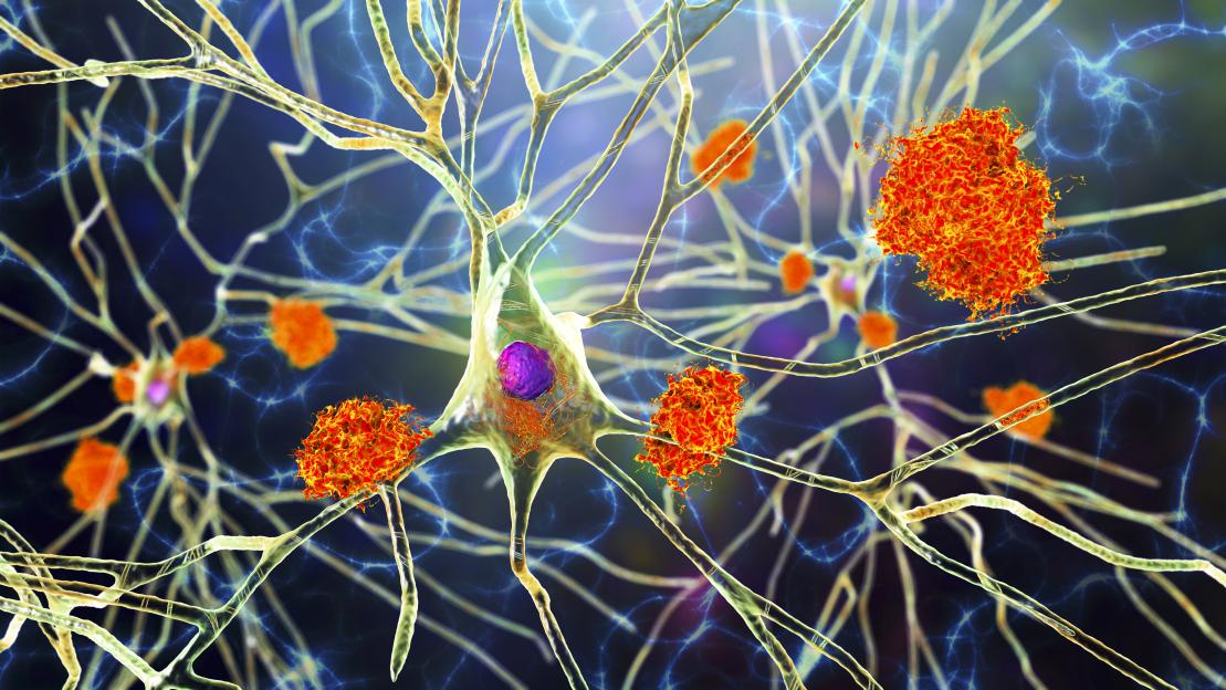 Alzheimers-disease-illustration-amyloid-plaques-886289955