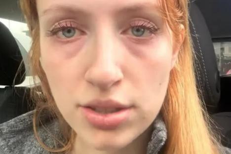 Everyone said I’d regret getting filler to to cover my undereye bags but I’m made up – the results speak for themselves