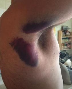 Large bruises on a man's torso and underarm.