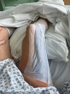 Woman's leg in hospital bed with bandage.