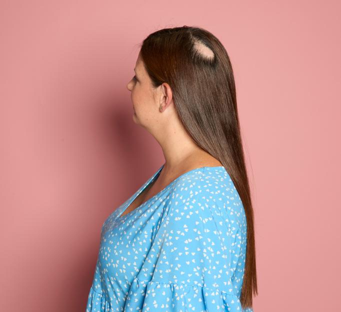 Woman with long brown hair, showing a bald patch on her scalp.