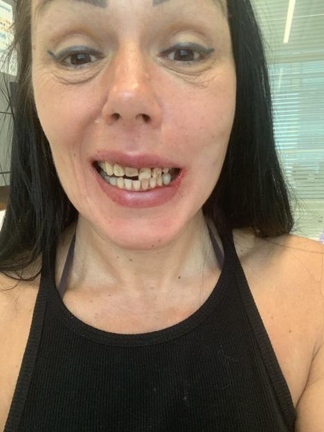 Woman with damaged teeth after assault.