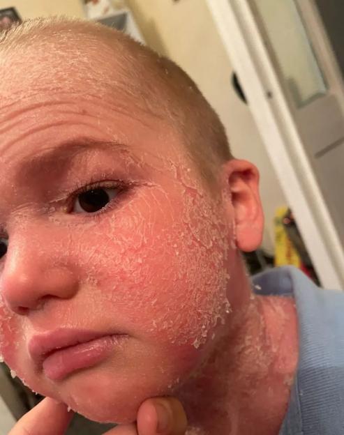 A close-up of a child's face and neck, with large areas of red, irritated, and peeling skin due to congenital ichthyosis.