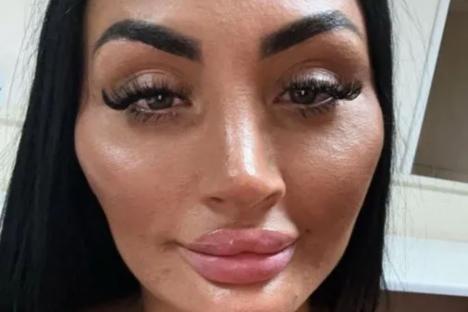 Love Island star unrecognisable after dissolving her lip, cheek and chin filler as she shows off VERY dramatic snaps