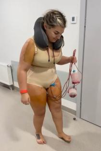 Woman in post-surgical recovery garment with drainage bags attached.