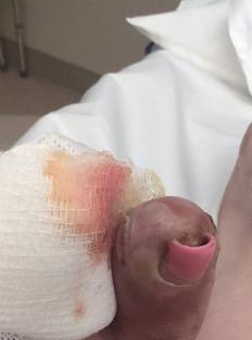 Close-up of a bandaged toe with an infected ingrown toenail.