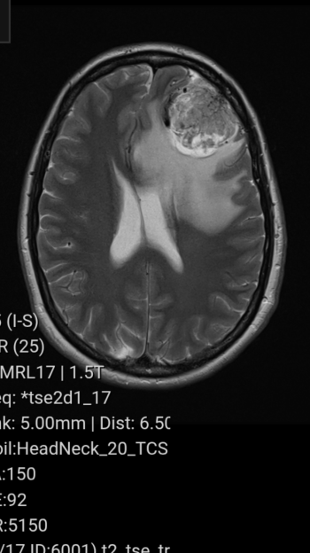 MRI scan of the brain showing a tumor.