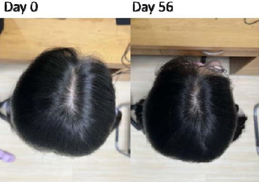 Collage of before and after images showing a person's scalp with significant hair regrowth after 56 days.