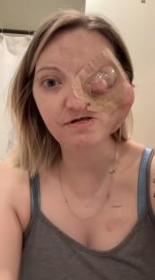 Woman with facial bandages and scars after cancer surgery.
