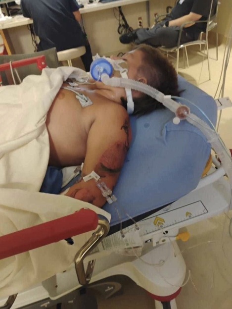 A person with multiple burns and tubes in their mouth and arm, lying on a hospital bed.