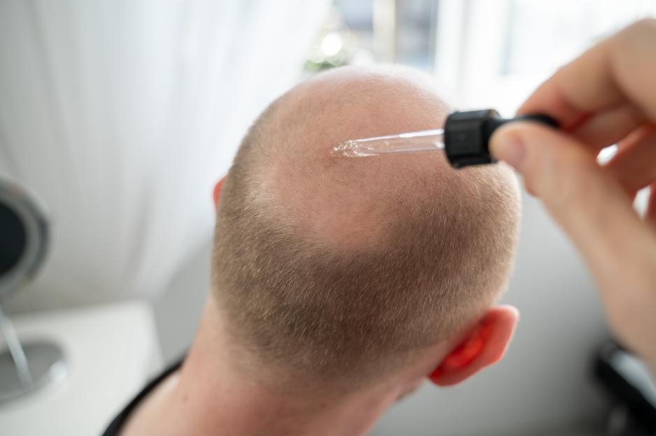 Breakthrough Baldness Remedy Unveiled: Stunning 8-Week Transformation Revealed in Before-and-After Photos!