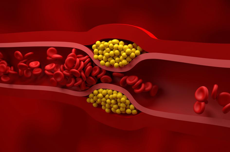 Illustration of an artery with atherosclerosis, showing fatty deposits (yellow) on the inner walls, narrowing the vessel and hindering blood flow.