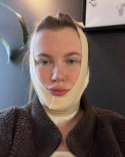 Woman wearing a post-surgical face lift bandage.