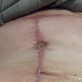 Surgical scar on a woman's abdomen.
