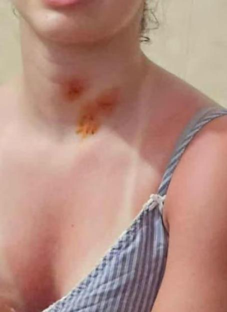 Three red bite marks on a person's neck.