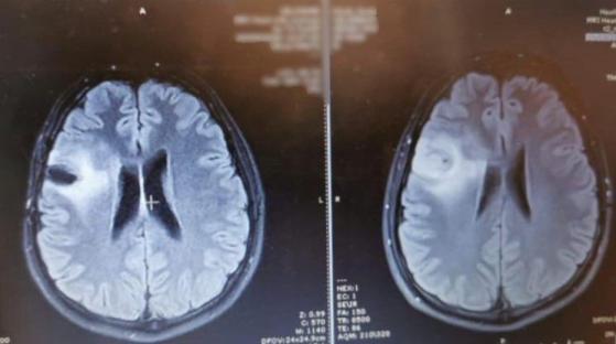 Brain scan showing a grade 2 astrocytoma.