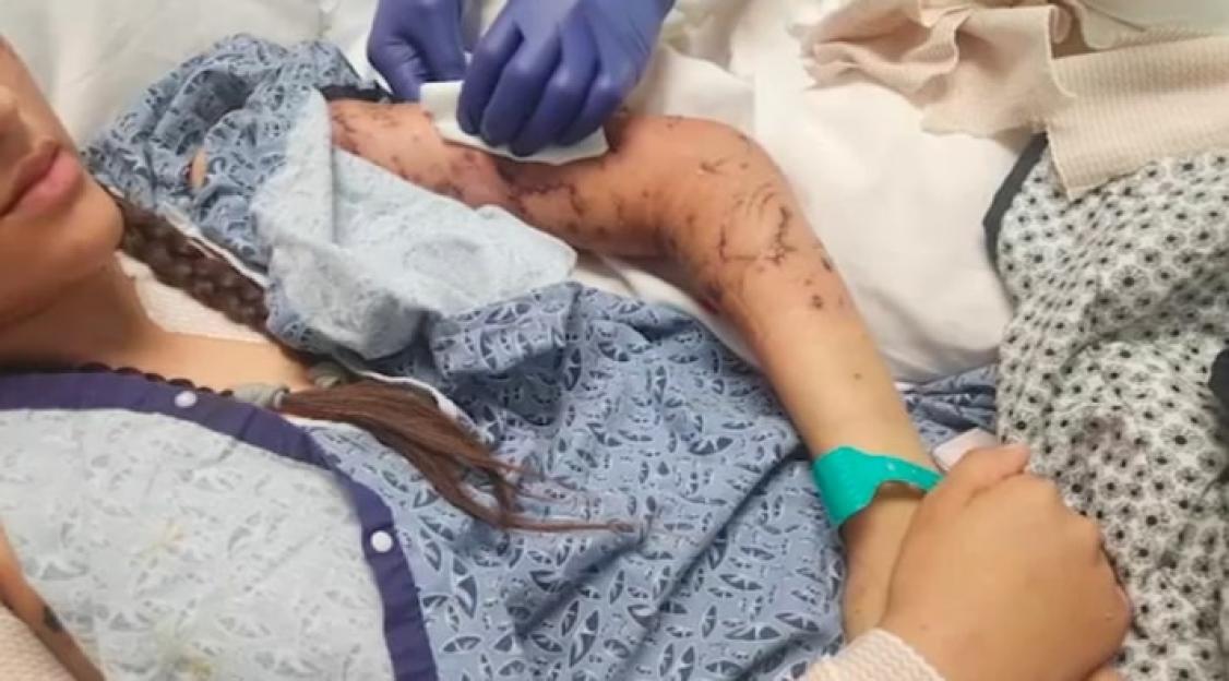 Teen girl with severe dog bite injuries receiving medical attention.