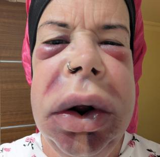 Close-up of a woman's severely bruised face after a dental procedure.