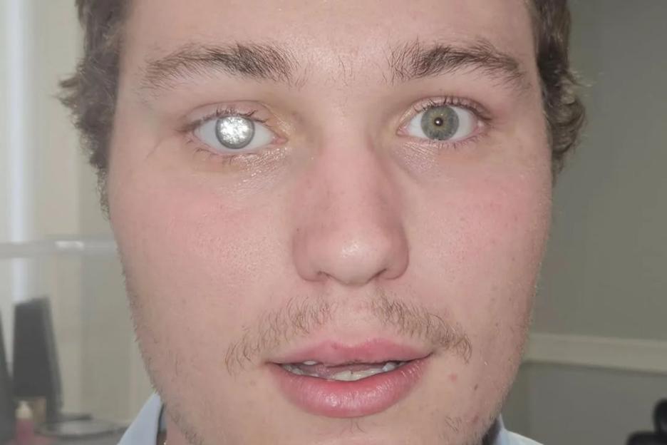 Jewellery Store Owner Channels Real-Life 'James Bond Villain' with £1.5 Million Diamond Eye Implant
