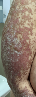 Close-up of skin affected by Lyell's syndrome.