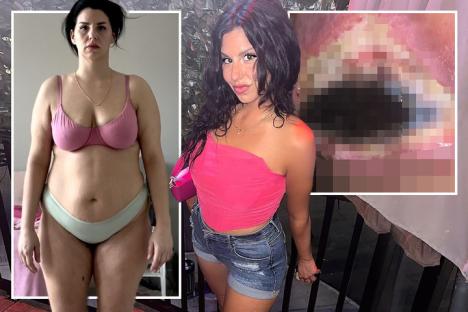 My flesh turned BLACK and rotted away after botched £19,000 mummy makeover – I’ve been left permamently deformed